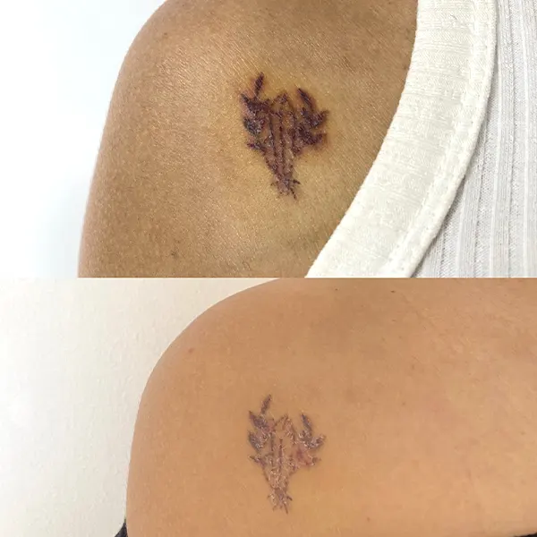Img-Medical_Skin_Derma-Servicios-Borrado_de_Tatuajes