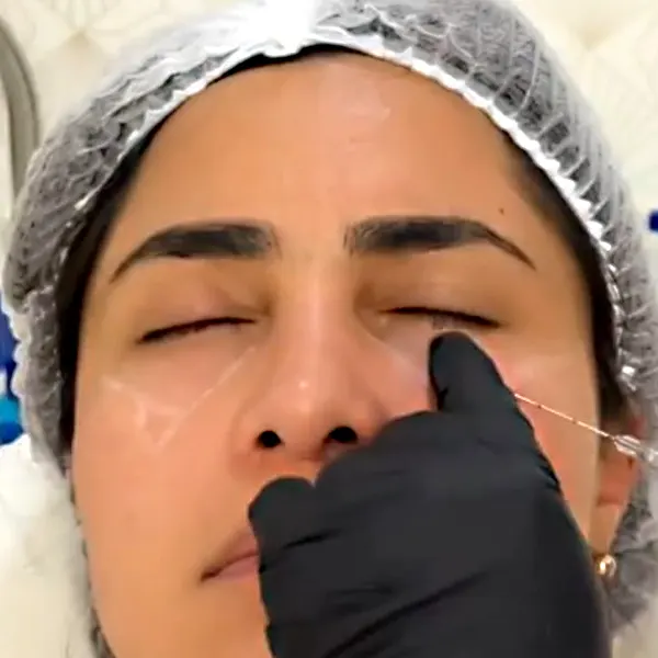 Img-Medical_Skin_Derma-Servicios-Ojeras